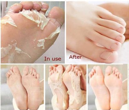 heel of foot peeling