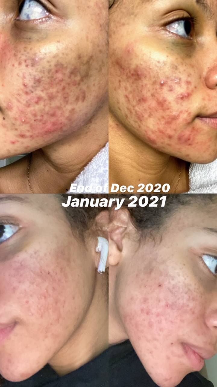 Top two photos show Jiminian's acne in December 2020. Bottom two photos show an improvement by January 2021.